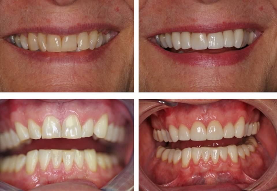 two before and after images showing patients' teeth after Boise teeth cleaning services