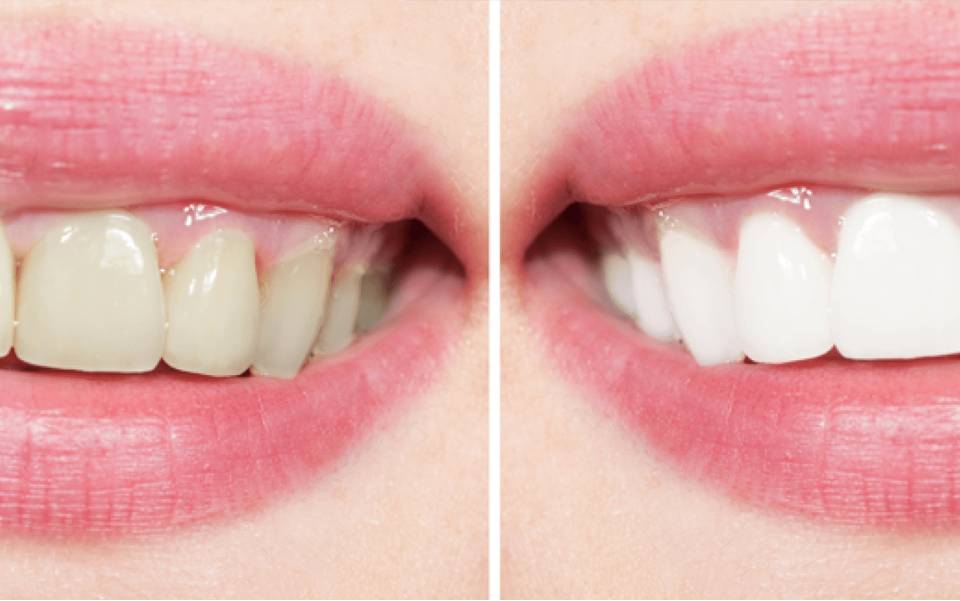 a before and after image of a woman's teeth after using Boise teeth cleaning services